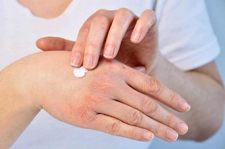 6 Cách Khắc Phục Da Khô Ngứa Trong Mùa Đông